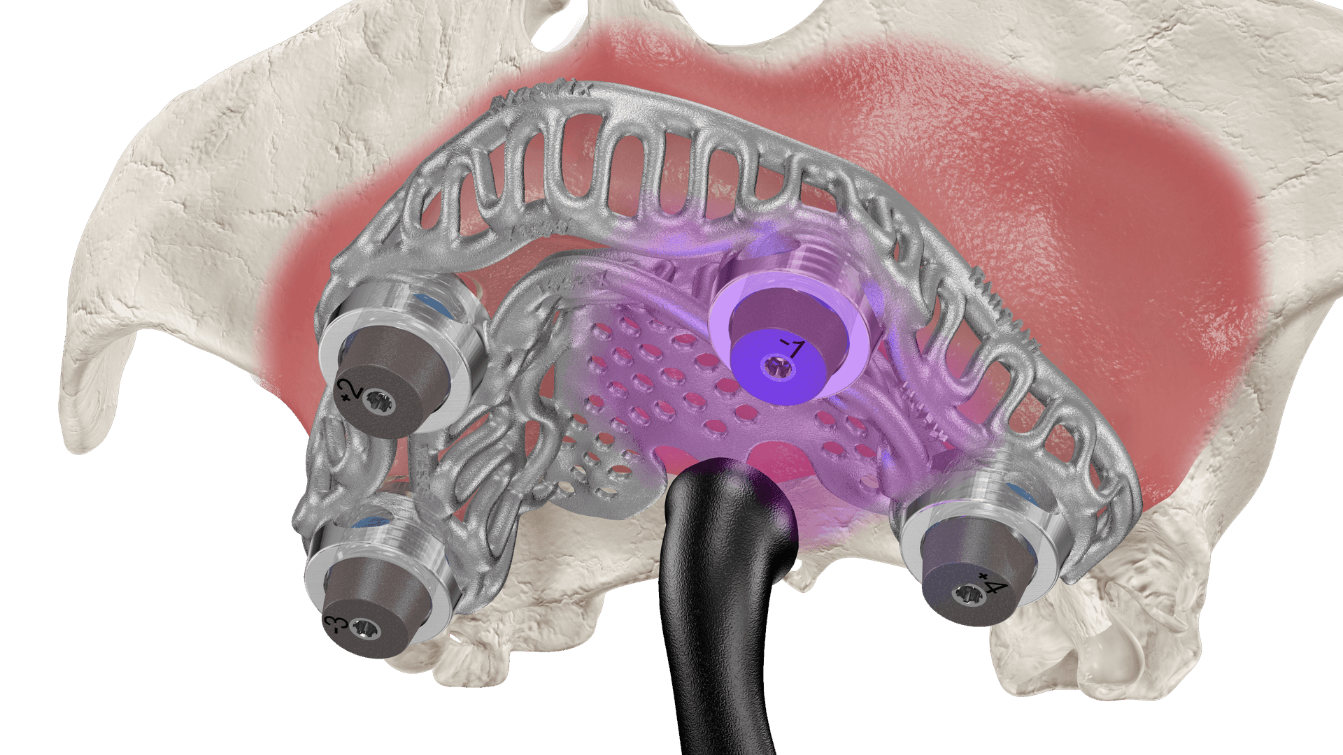 IOSFIX PREMIUM garantiza el ajuste pasivo.